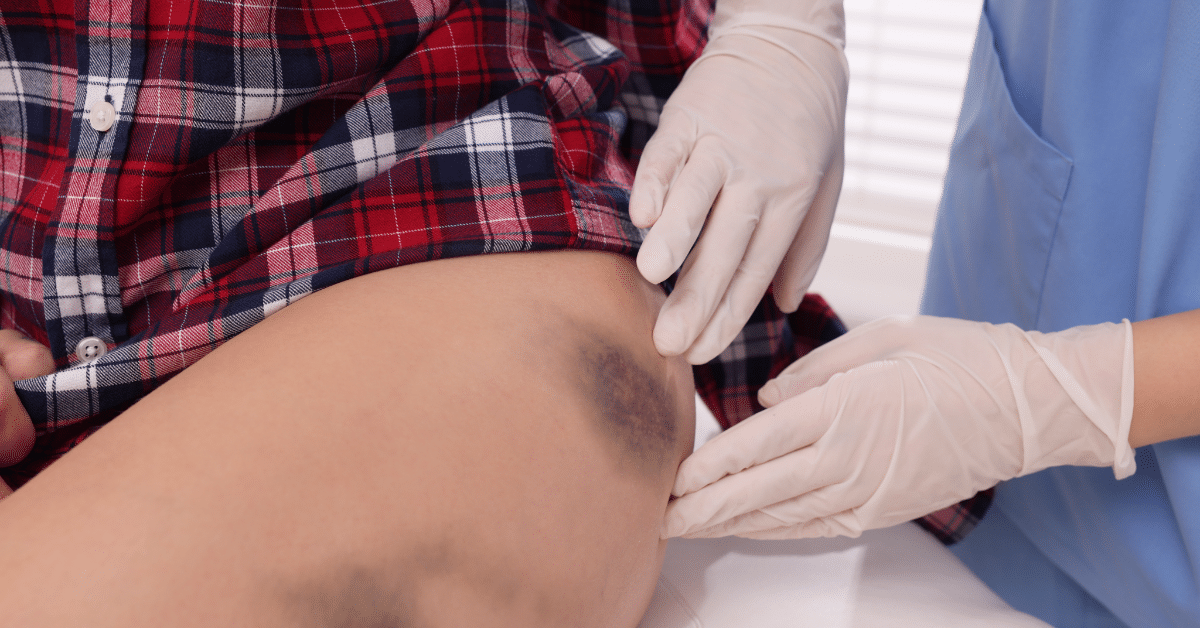 thoracic bruse on thigh