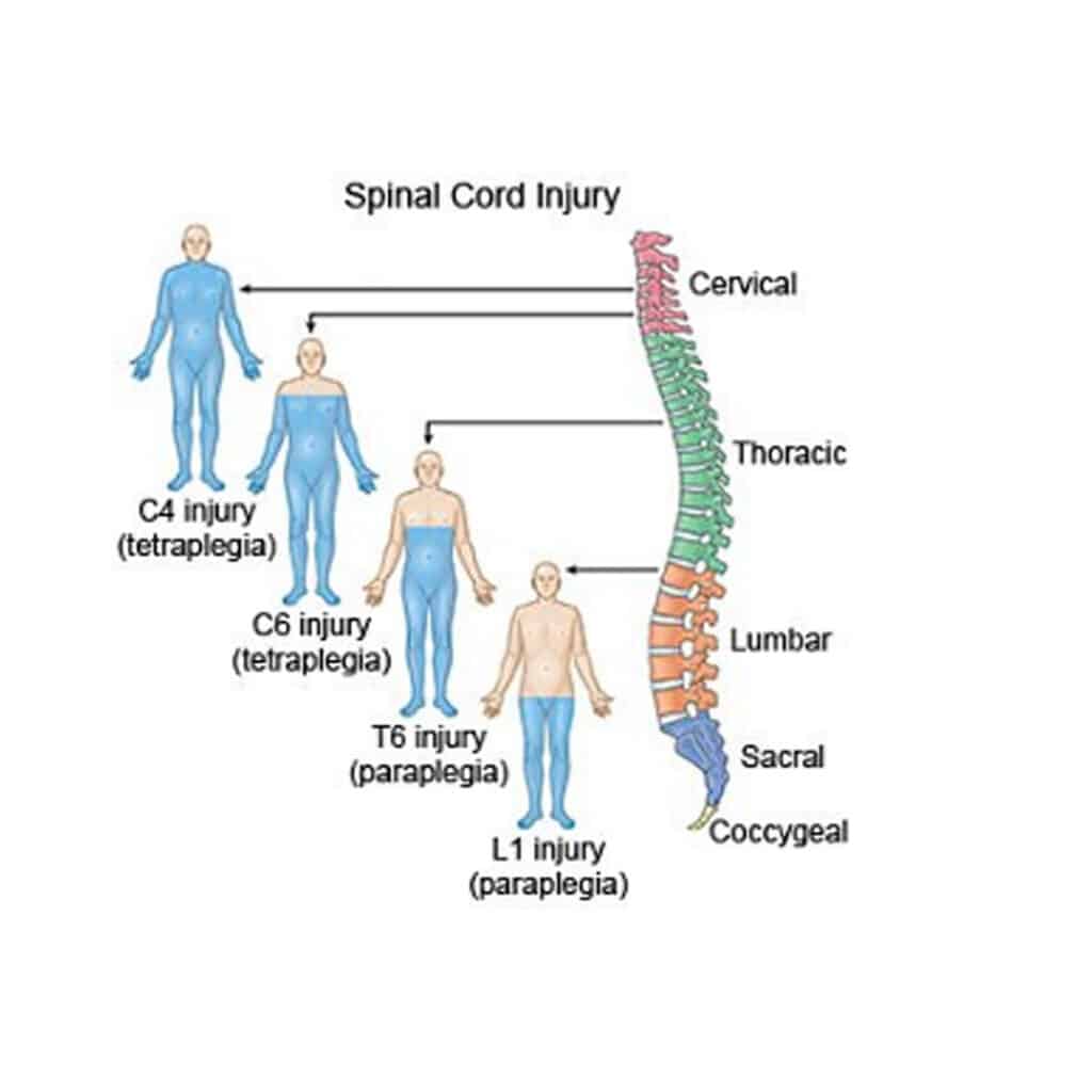 A graphic showing the spine, and the types and locations of spinal cord injuries on the body.