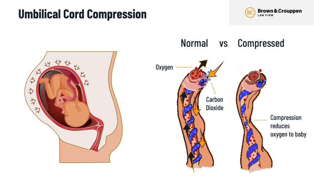 Infographic detailing a normal vs compressed umbilical cord - What is umbilical cord compression